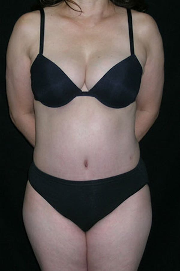Tummy Tuck Before & After Gallery - Patient 23533917 - Image 2