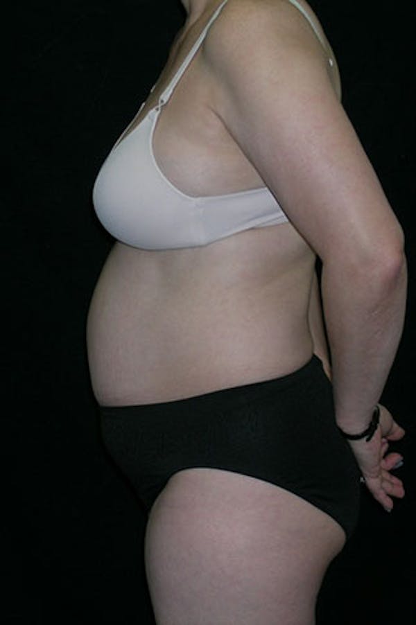 Tummy Tuck Before & After Gallery - Patient 23533917 - Image 3