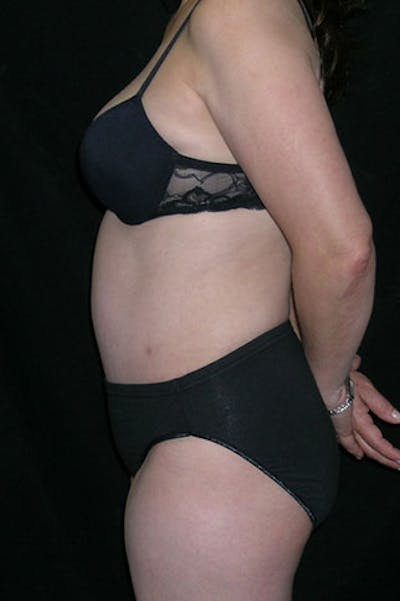 Tummy Tuck Before & After Gallery - Patient 23533917 - Image 4