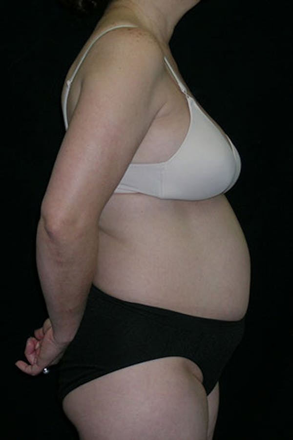 Tummy Tuck Before & After Gallery - Patient 23533917 - Image 5