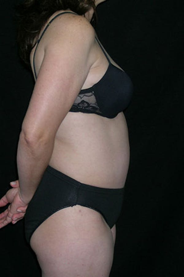 Tummy Tuck Before & After Gallery - Patient 23533917 - Image 6