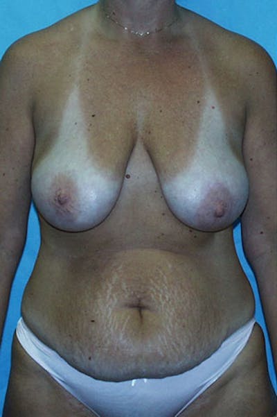 Mommy Makeover Gallery - Patient 23533936 - Image 1