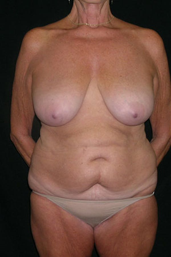 Mommy Makeover Gallery - Patient 23533955 - Image 1