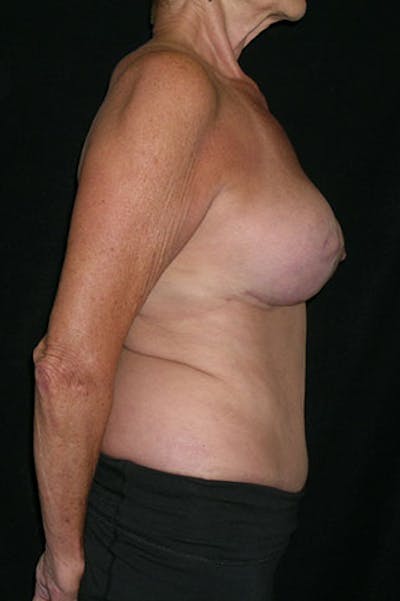 Mommy Makeover Before & After Gallery - Patient 23533955 - Image 8