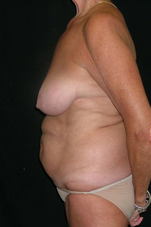 Mommy Makeover Gallery - Patient 23533955 - Image 9
