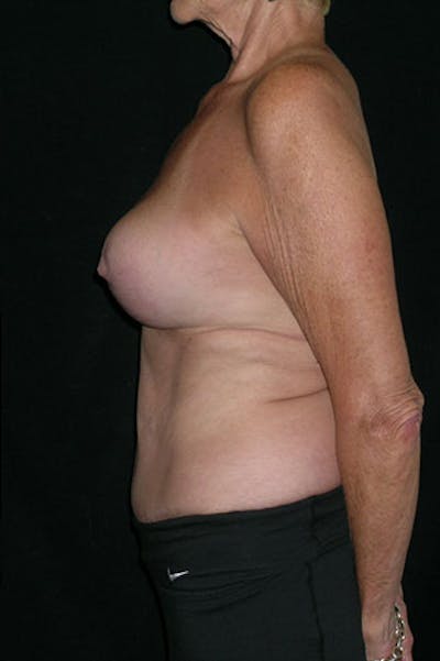Mommy Makeover Before & After Gallery - Patient 23533955 - Image 10