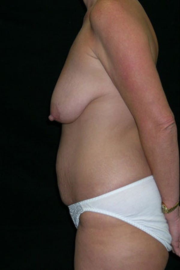 Mommy Makeover Before & After Gallery - Patient 23533962 - Image 7