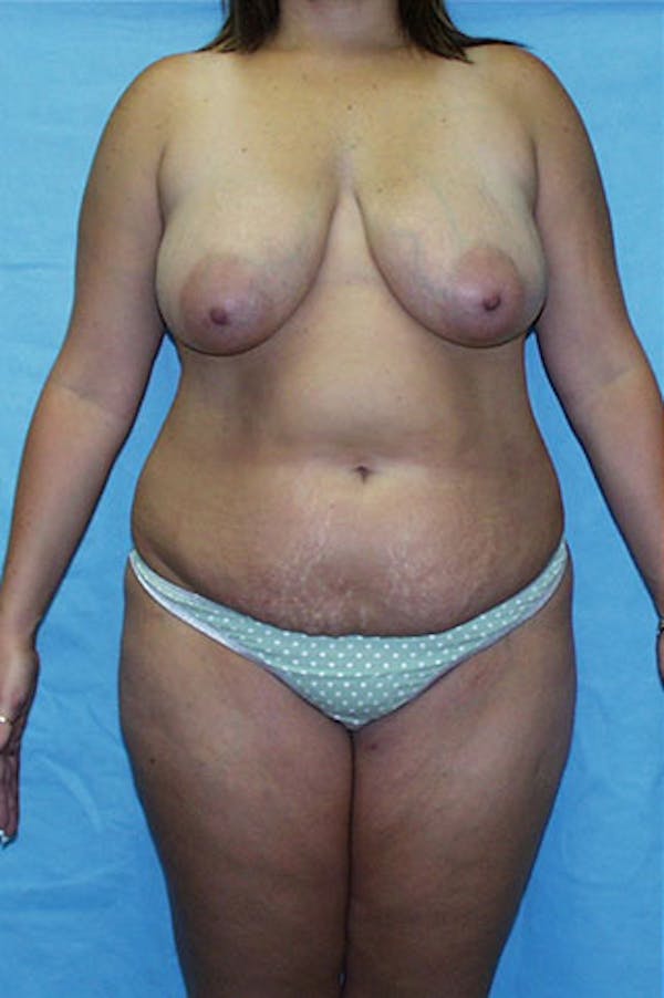Mommy Makeover Gallery - Patient 23533965 - Image 1