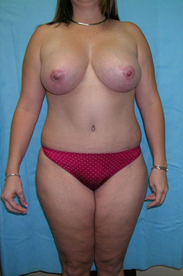 Mommy Makeover Gallery - Patient 23533965 - Image 2