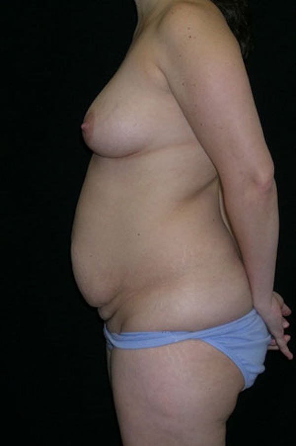 Mommy Makeover Before & After Gallery - Patient 23533991 - Image 3