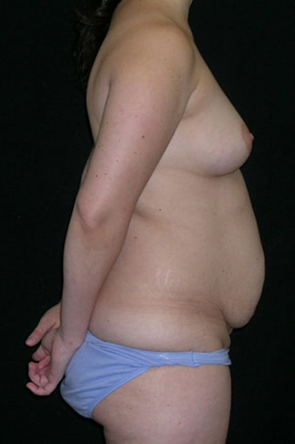 Mommy Makeover Before & After Gallery - Patient 23533991 - Image 9