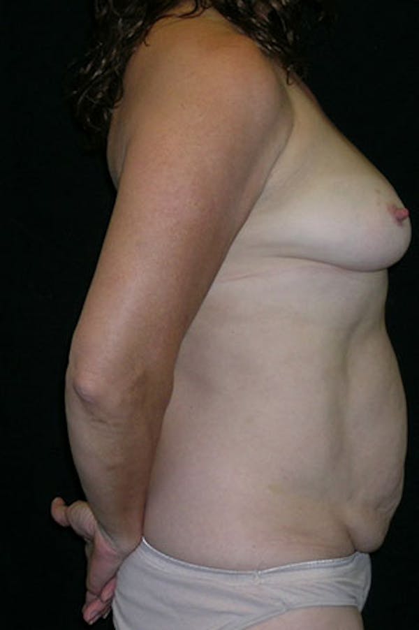 Mommy Makeover Before & After Gallery - Patient 23533994 - Image 3