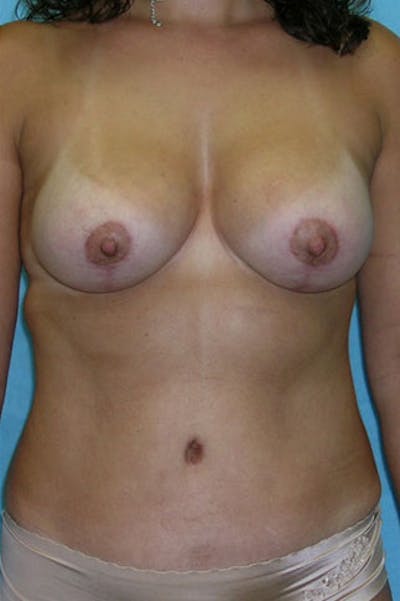 Mommy Makeover Before & After Gallery - Patient 23534001 - Image 2