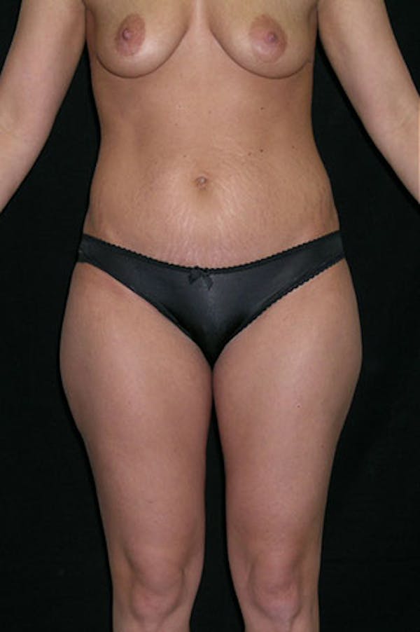 Mommy Makeover Before & After Gallery - Patient 23534006 - Image 1