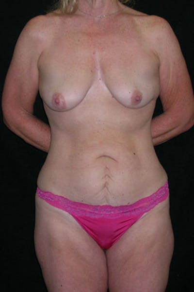 Mommy Makeover Before & After Gallery - Patient 23534016 - Image 1