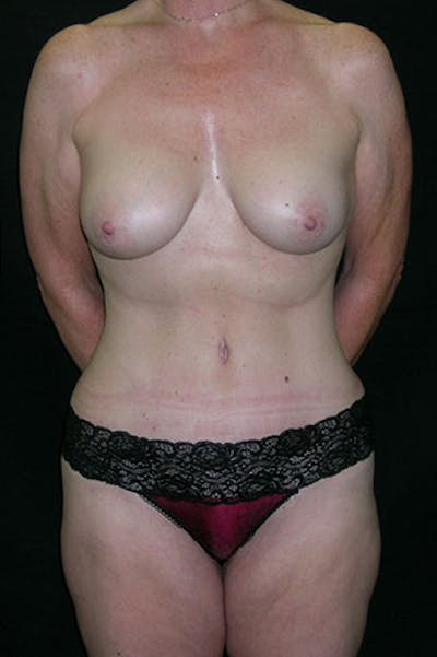 Mommy Makeover Before & After Gallery - Patient 23534016 - Image 2