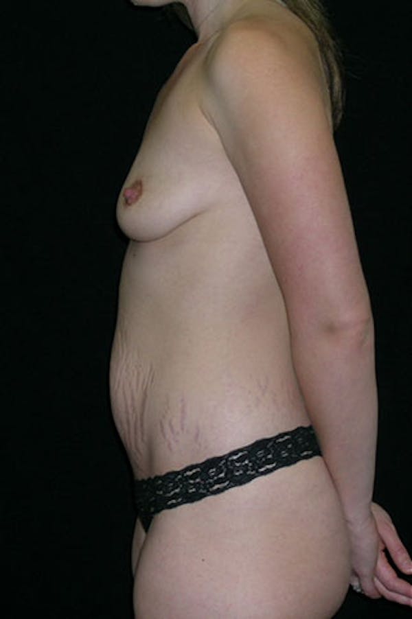 Mommy Makeover Before & After Gallery - Patient 23534019 - Image 5