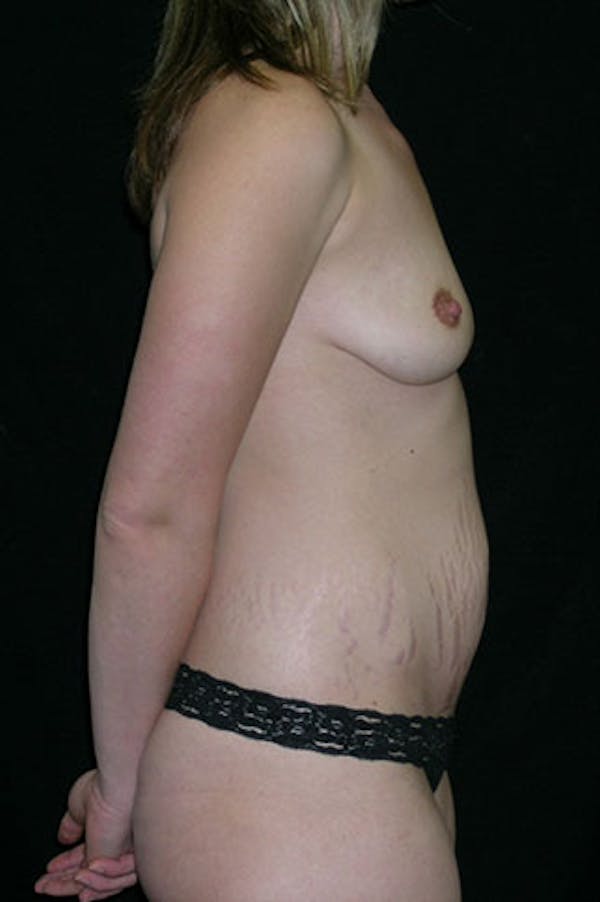 Mommy Makeover Gallery - Patient 23534019 - Image 7