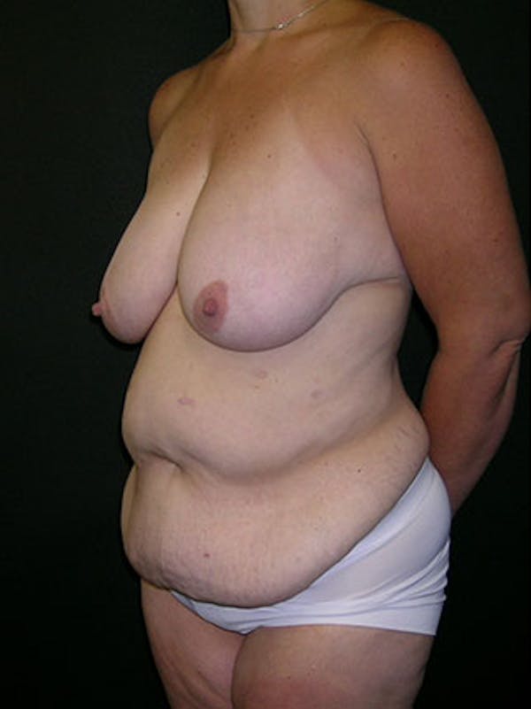 Mommy Makeover Before & After Gallery - Patient 23534028 - Image 9