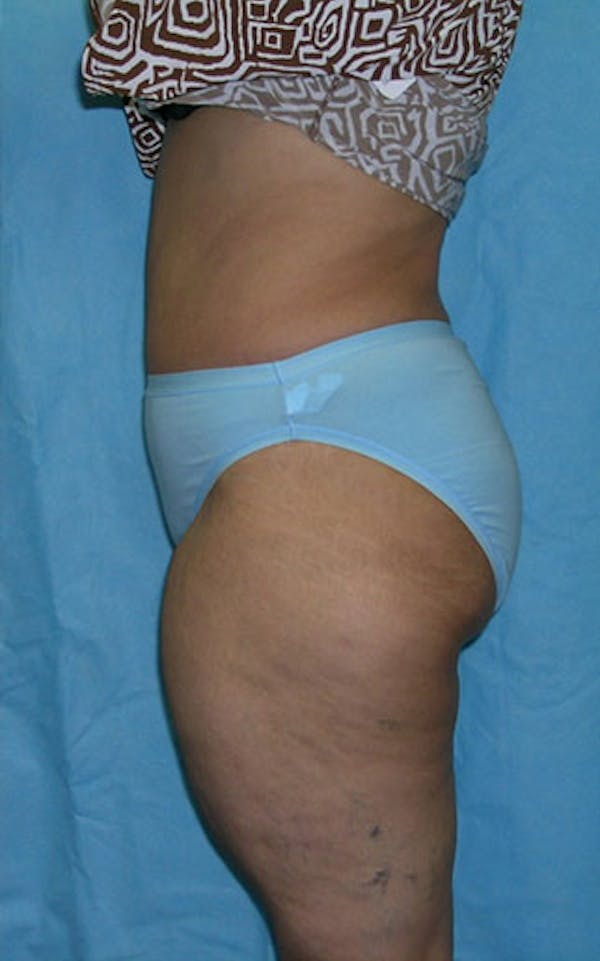 Tummy Tuck