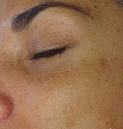 HydraFacial Before & After Gallery - Patient 61447365 - Image 1