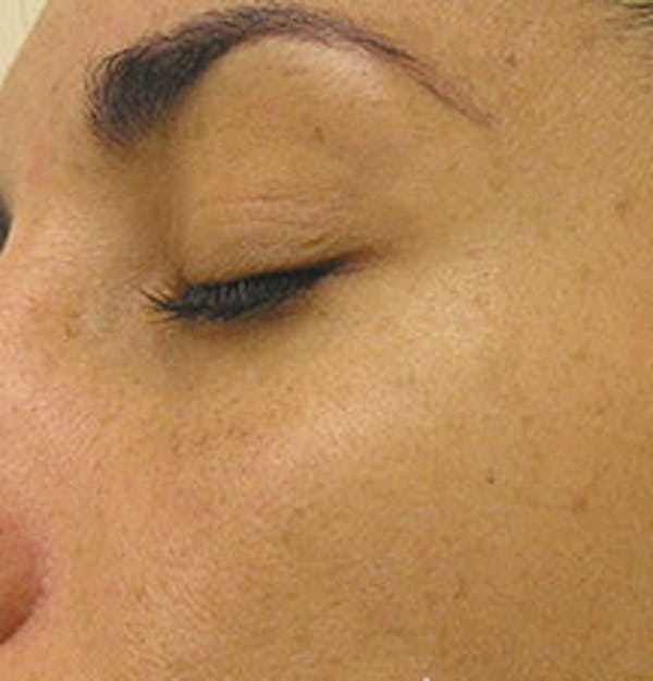 HydraFacial Before & After Gallery - Patient 61447365 - Image 2