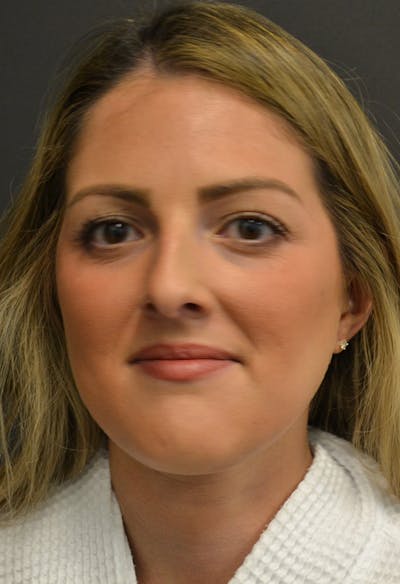 Rhinoplasty Before & After Gallery - Patient 146622556 - Image 1