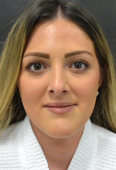 Rhinoplasty Before & After Gallery - Patient 146622556 - Image 4