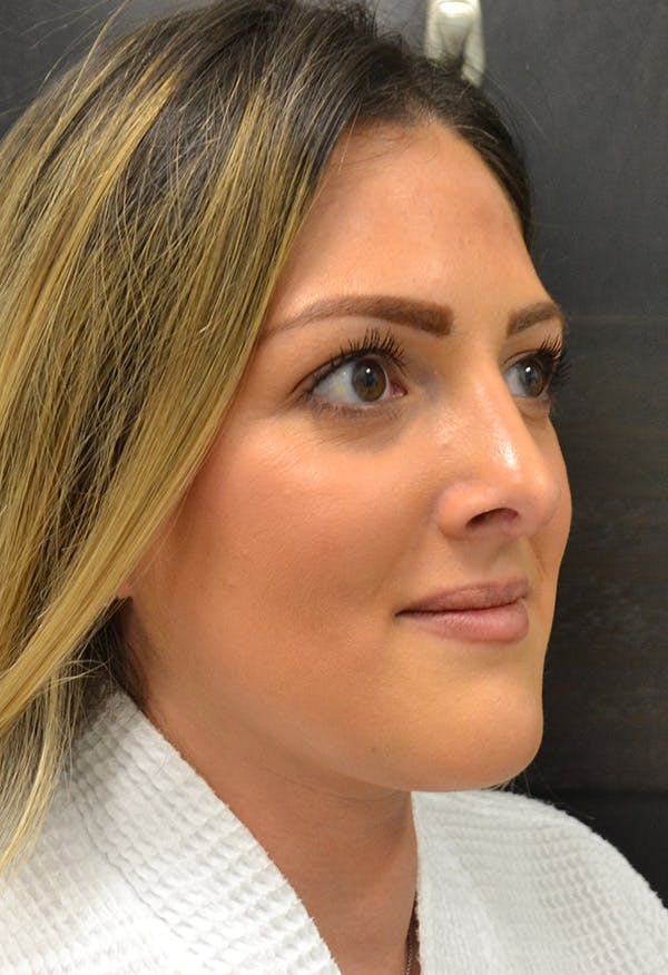 Rhinoplasty Before & After Gallery - Patient 146622556 - Image 4