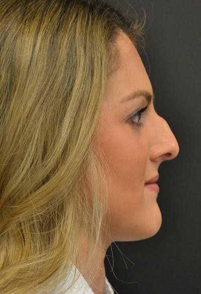 Rhinoplasty Before & After Gallery - Patient 146622556 - Image 1