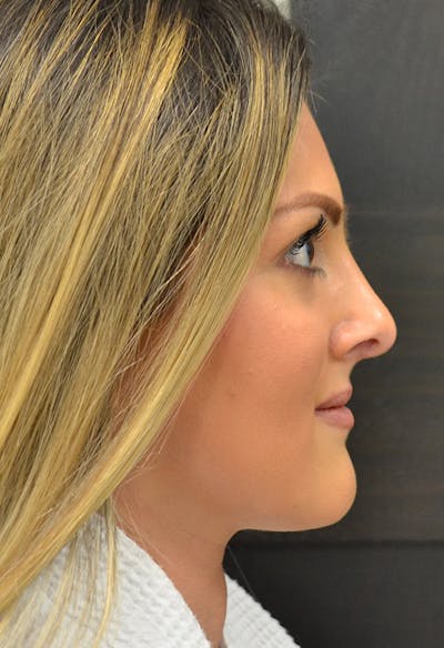 Rhinoplasty Before & After Gallery - Patient 146622556 - Image 6