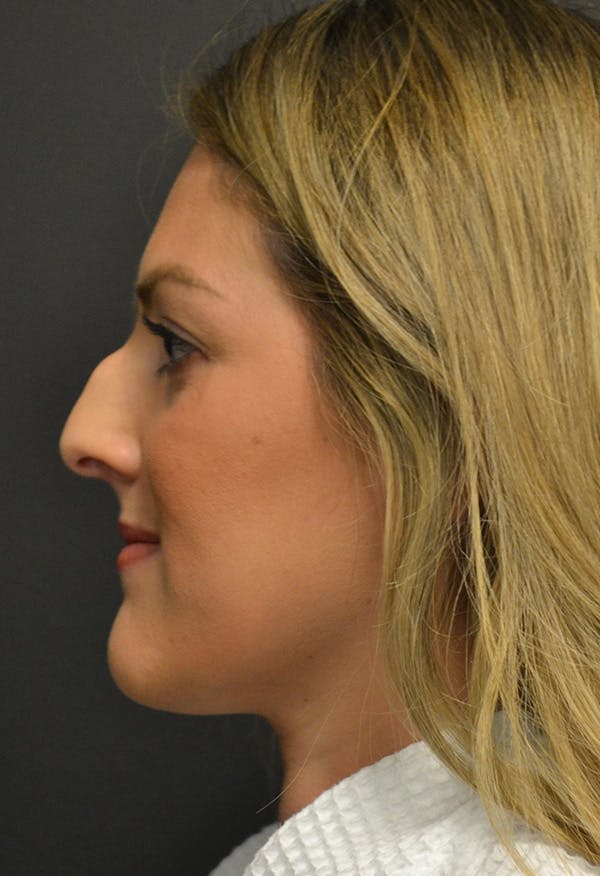 Rhinoplasty Before & After Gallery - Patient 146622556 - Image 9