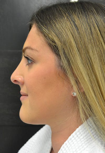 Rhinoplasty Before & After Gallery - Patient 146622556 - Image 10
