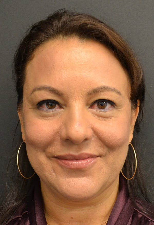 Blepharoplasty Before & After Gallery - Patient 146622592 - Image 1