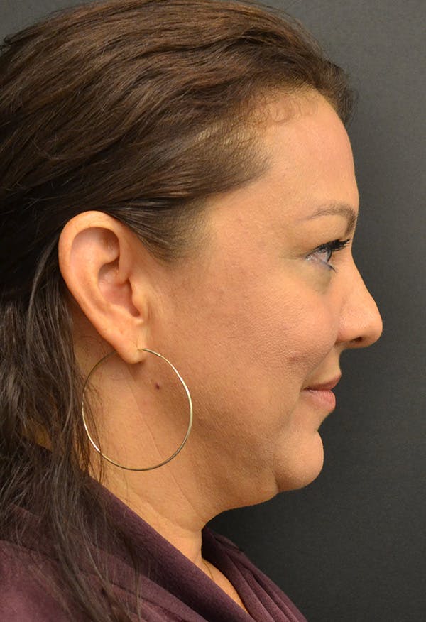 Neck Lift Before & After Gallery - Patient 146622591 - Image 7