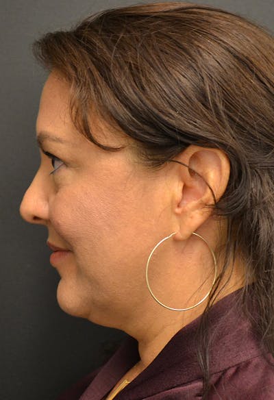 Neck Lift Before & After Gallery - Patient 146622591 - Image 1