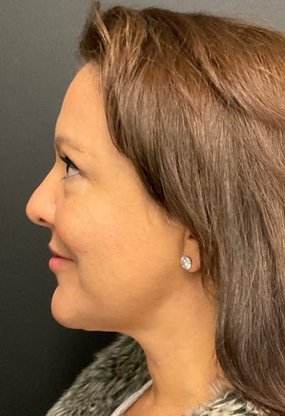 FaceTite Before & After Gallery - Patient 146622640 - Image 10