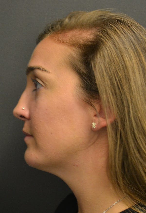 FaceTite Before & After Gallery - Patient 146622651 - Image 9
