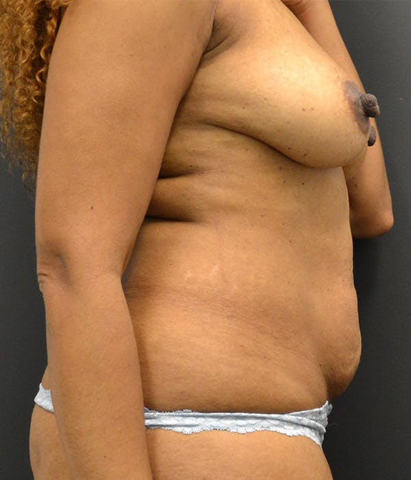 Tummy Tuck Before & After Gallery - Patient 146622653 - Image 5
