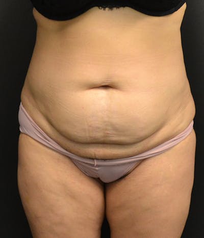 Tummy Tuck Before & After Gallery - Patient 146622580 - Image 1