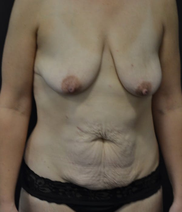 Breast Augmentation Before & After Gallery - Patient 146622658 - Image 1