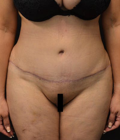 Fat Grafting Before & After Gallery - Patient 146622586 - Image 6