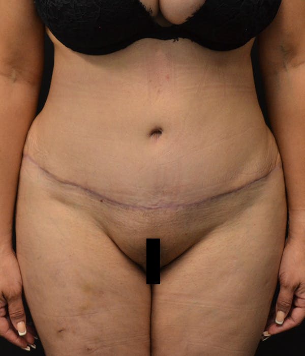 Tummy Tuck Before & After Gallery - Patient 146622580 - Image 2