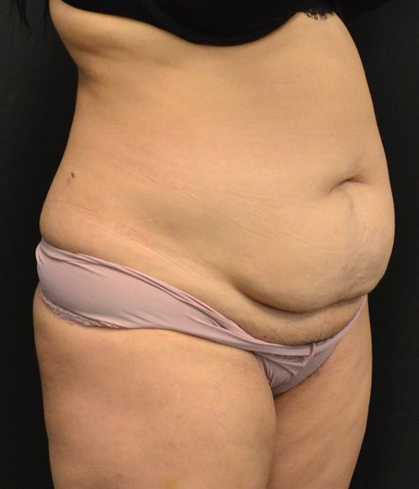 Tummy Tuck Before & After Gallery - Patient 146622580 - Image 3