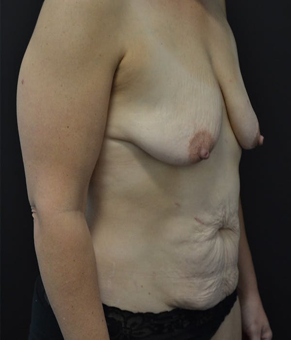 Breast Augmentation Before & After Gallery - Patient 146622658 - Image 3