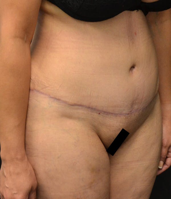 Tummy Tuck Before & After Gallery - Patient 146622580 - Image 4