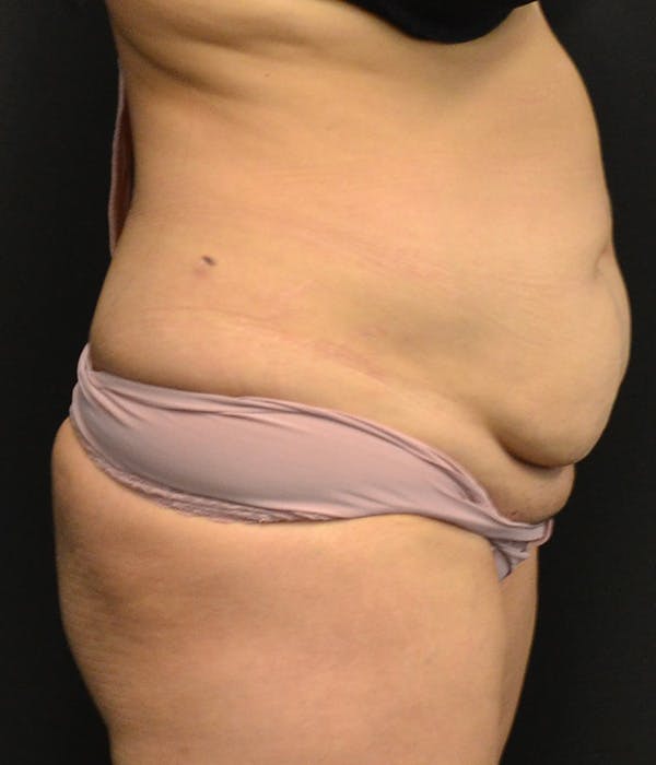 Tummy Tuck Before & After Gallery - Patient 146622580 - Image 5