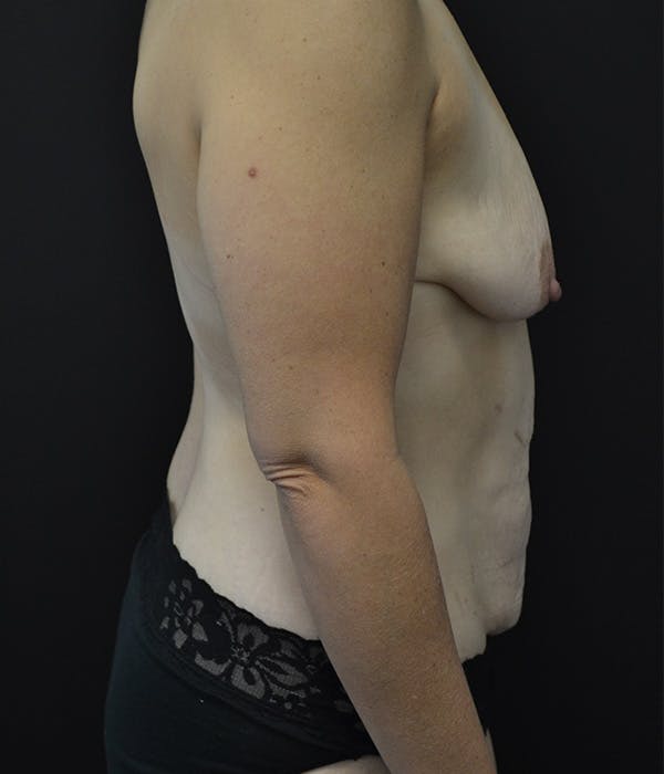 Breast Augmentation Before & After Gallery - Patient 146622658 - Image 5