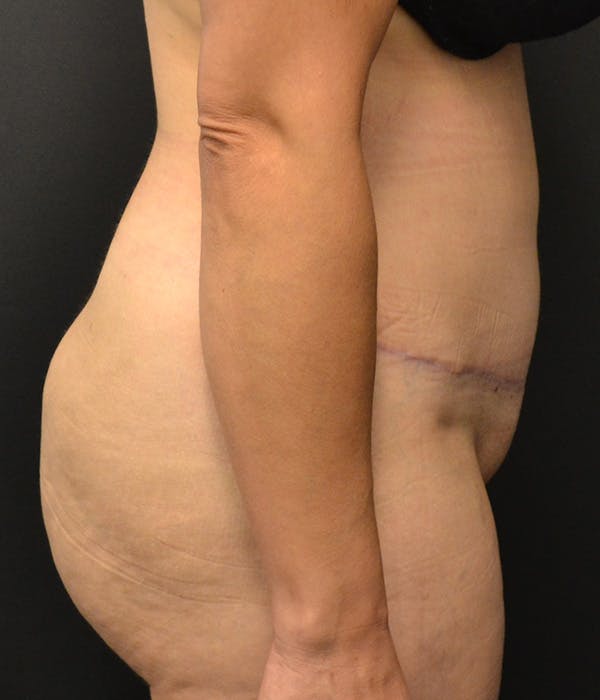 Tummy Tuck Before & After Gallery - Patient 146622580 - Image 6