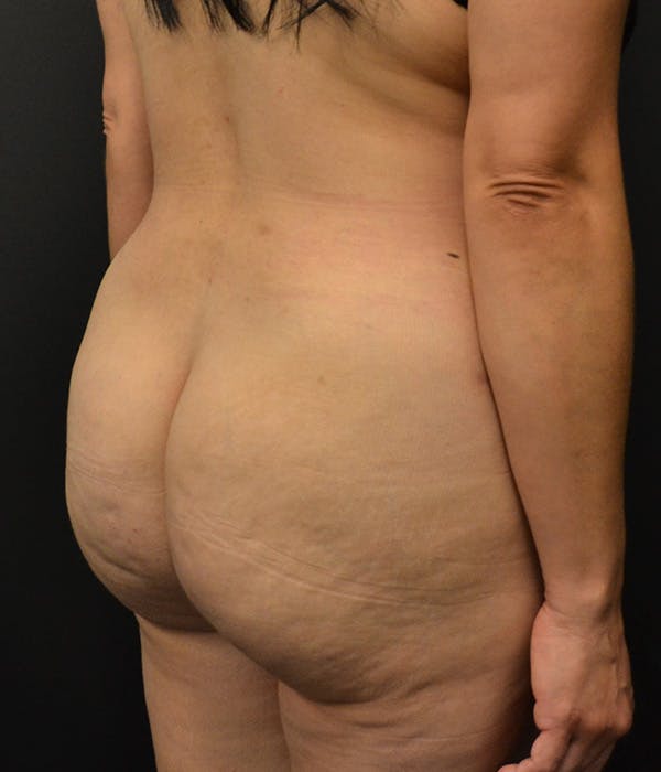 Fat Grafting Before & After Gallery - Patient 146622586 - Image 4